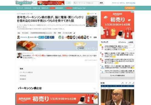 パーキンソン病という、割とメジャーな難病があります。マイケルJフォックスやモハメドアリや、最近ではみのもんたさんが発表されていました。これの外科的対処の代表がこのDBS手術で、私は2021年末にこ..